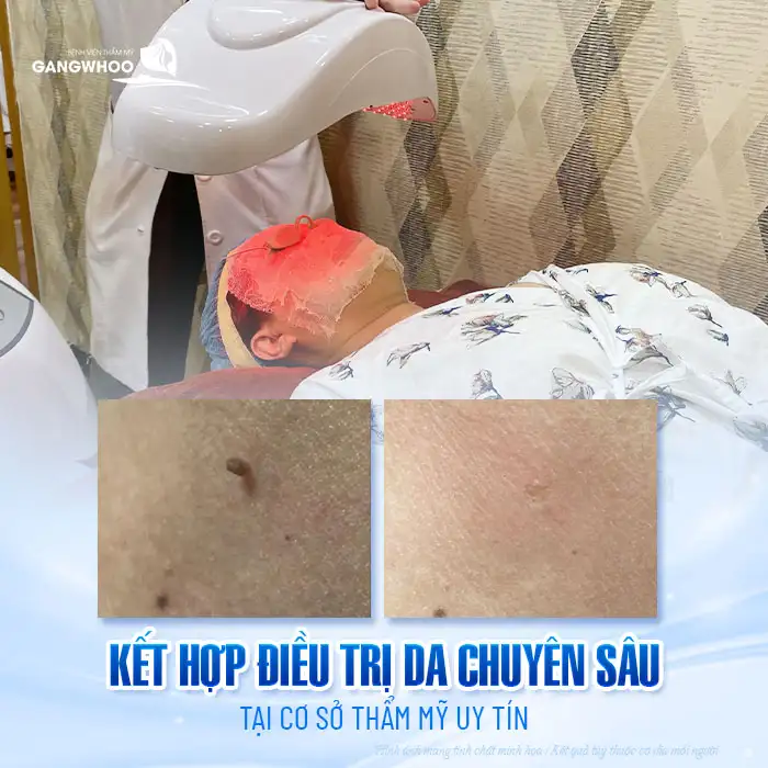 9+ Cách điều trị mụn thịt trên mặt an toàn, hiệu quả nhanh chóng