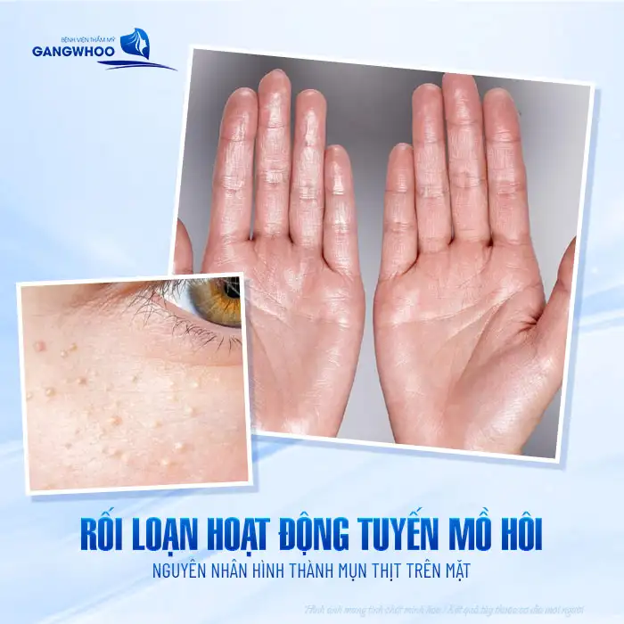 9+ Cách điều trị mụn thịt trên mặt an toàn, hiệu quả nhanh chóng