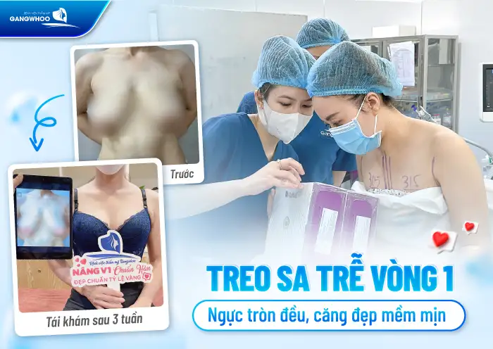 Bật mí cách nâng ngực chảy xệ hiệu quả, an toàn tại nhà