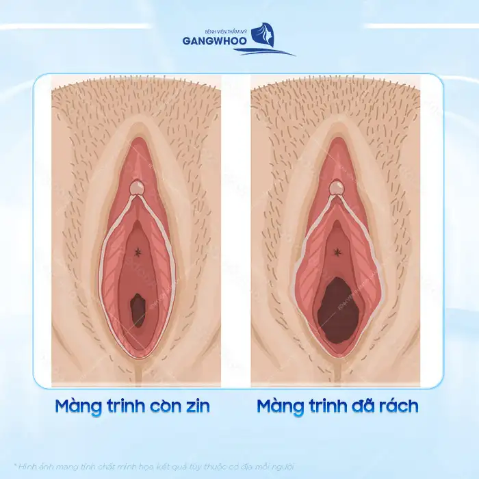 Hướng dẫn cách nhận biết màng trinh vá so với màng trinh chưa vá