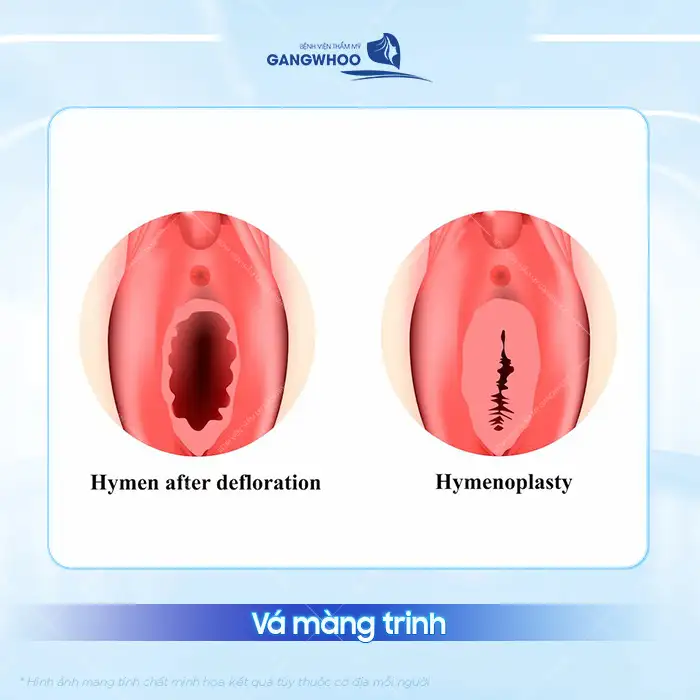 Hướng dẫn cách nhận biết màng trinh vá so với màng trinh chưa vá