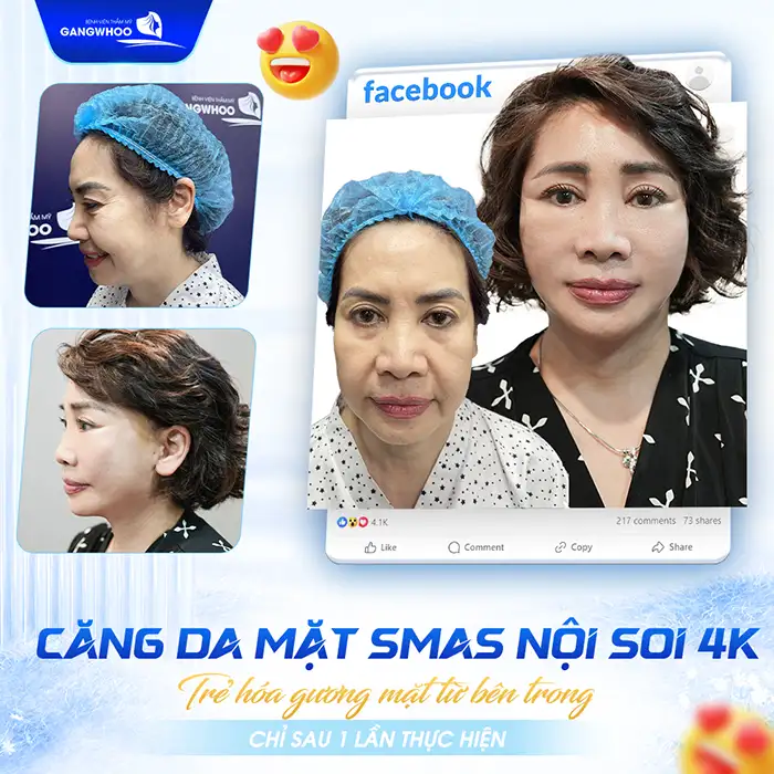 Căng chỉ da mặt giữ được bao lâu? Cách duy trì lâu dài ra sao?