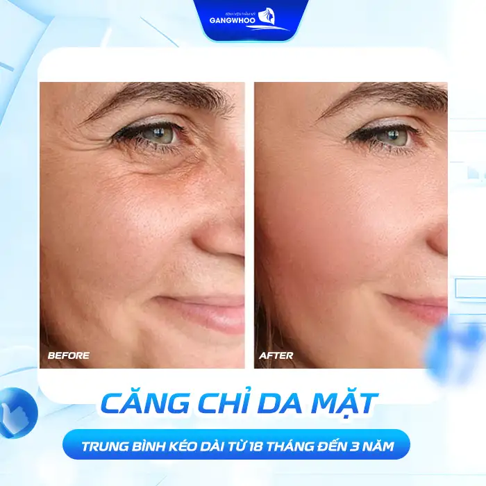 Căng chỉ da mặt giữ được bao lâu? Cách duy trì lâu dài ra sao?