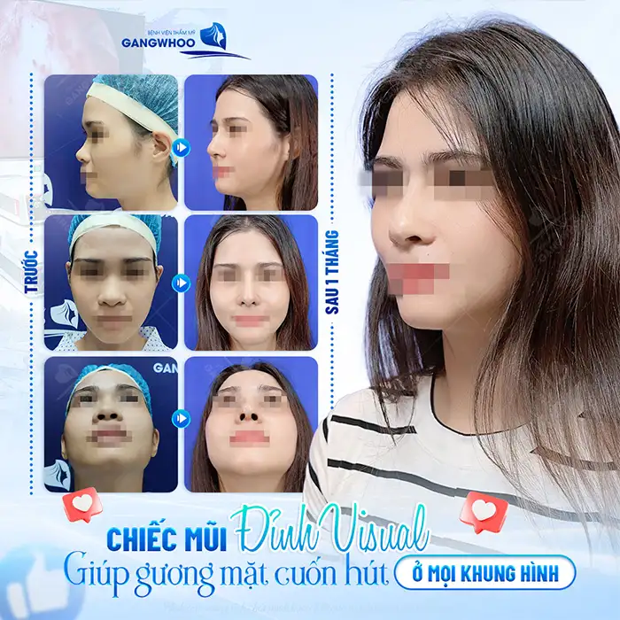 Nâng mũi bằng cách bấm huyệt có hiệu quả không? Có nên thực hiện