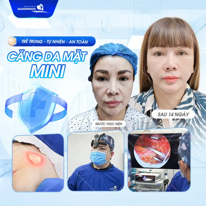 Căng da mặt mini là gì? Ưu. nhược điểm của phương pháp này là gì?