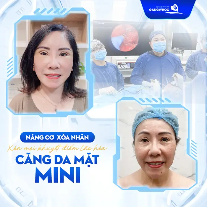 Căng da mặt mini là gì? Ưu. nhược điểm của phương pháp này là gì?