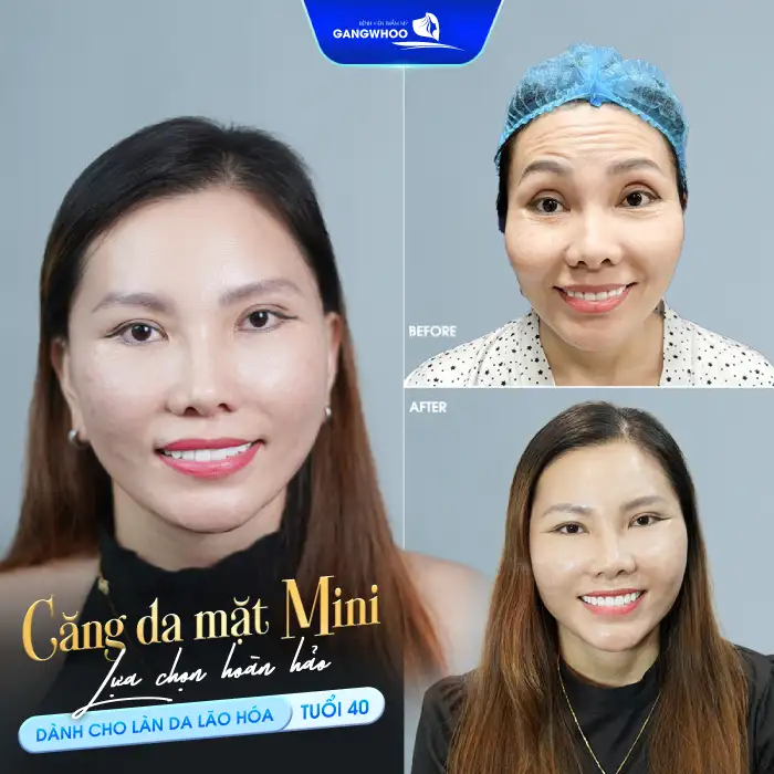 Căng da mặt mini là gì? Ưu. nhược điểm của phương pháp này là gì?