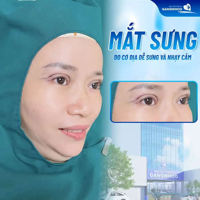 Cắt mí 2 tháng, 3 tháng vẩn sưng nguyên nhân do đâu? Cách khắc phục là gì?