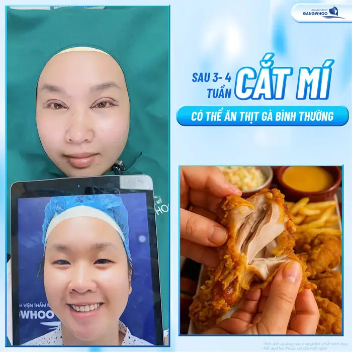 Cắt mí bao lâu thì ăn được thịt gà để tránh vết thương bị sưng