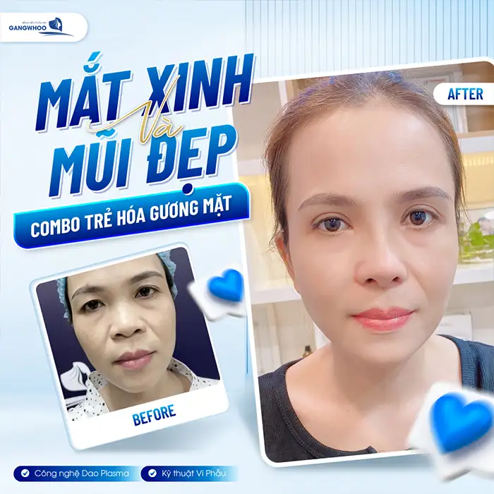 Cắt mí bao lâu hết sưng? Cách giảm sưng hiệu quả là gì?