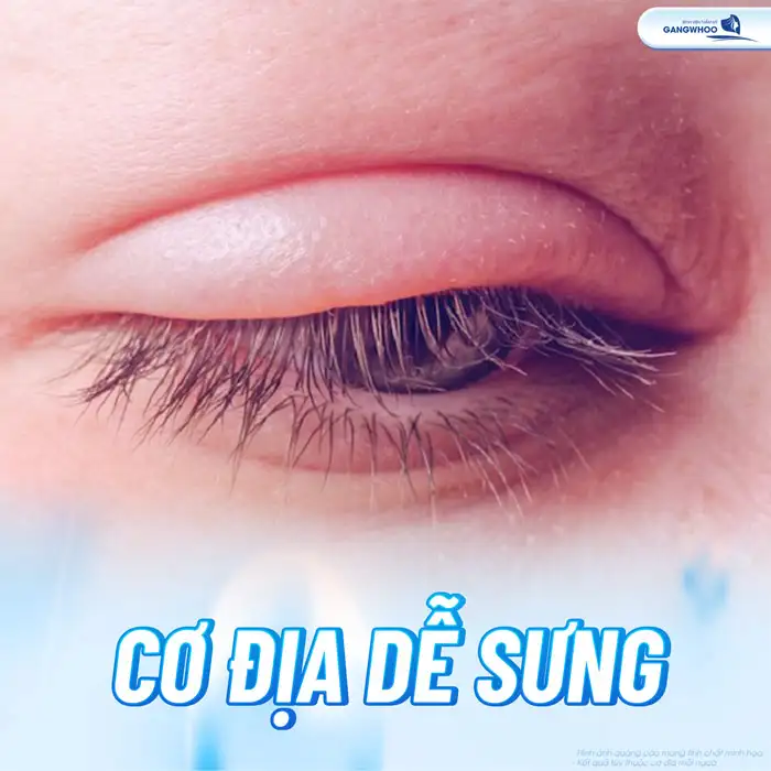 Cắt mí bao lâu hết sưng? Cách giảm sưng hiệu quả là gì?
