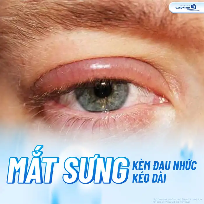 Cắt mí bao lâu hết sưng? Cách giảm sưng hiệu quả là gì?