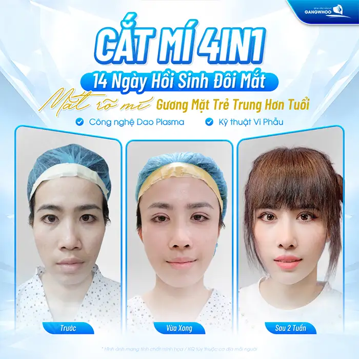 So sánh phương pháp cắt mí full và mini? Khác nhau ở điểm nào?