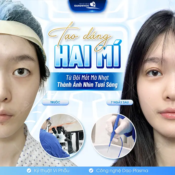 Cắt mí Hàn Quốc ở đâu đẹp? Tham khảo 7 địa chỉ an toàn, uy tín