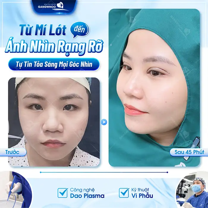 Cắt mí Hàn Quốc ở đâu đẹp? Tham khảo 7 địa chỉ an toàn, uy tín