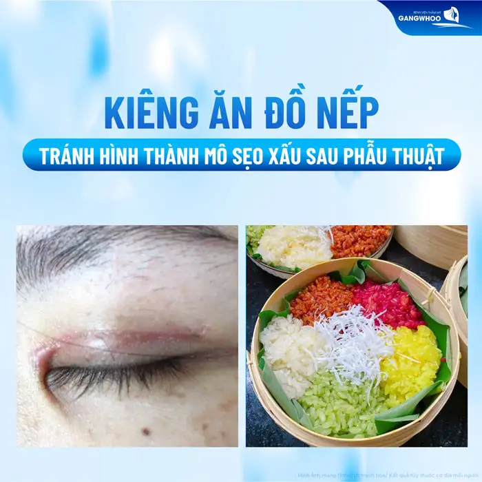 Cắt mí kiêng đồ nếp bao lâu? Vì sao cần phải kiêng ăn đồ nếp?