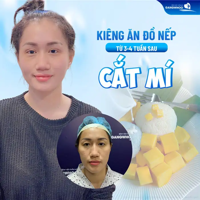 Cắt mí kiêng đồ nếp bao lâu? Vì sao cần phải kiêng ăn đồ nếp?