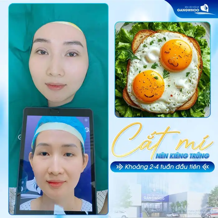 Cắt mí kiêng trứng bao lâu? Khi nào thì được ăn trứng?