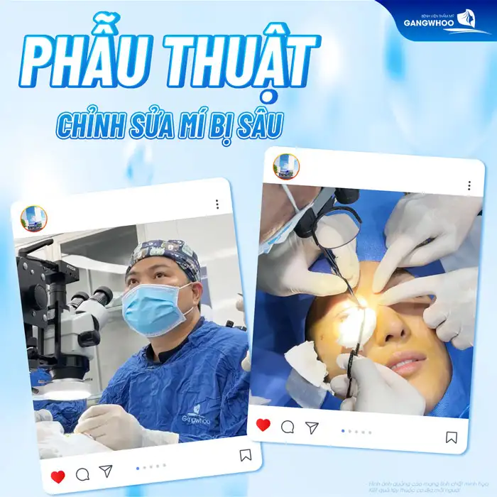 Cắt mí mắt bị sâu nguyên nhân do đâu? Có xử lý được không?
