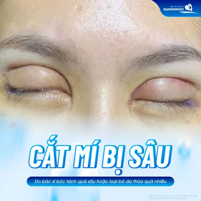 Cắt mí mắt bị sâu nguyên nhân do đâu? Có xử lý được không?