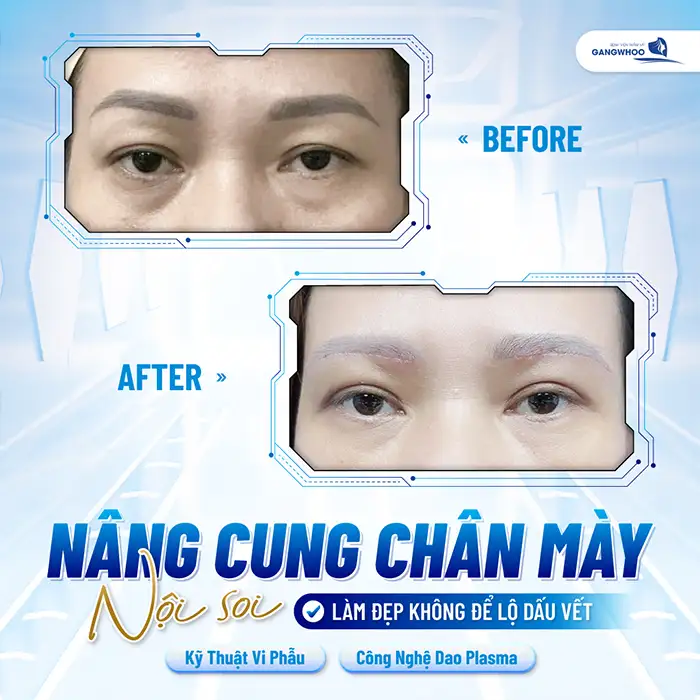 Phương pháp cắt mí mắt bị sụp là gì? Có nên thực hiện không?