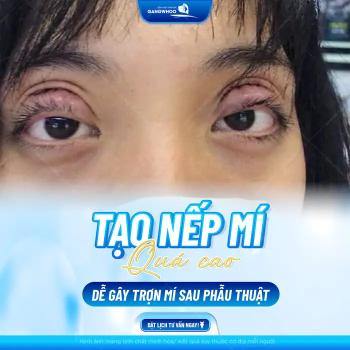 Cắt mí mắt bị trợn thì phải làm sao? Có sửa được không?