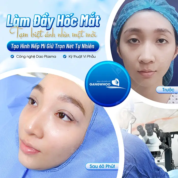 Cắt mí mắt có được vĩnh viễn không? Cách duy trì mí mắt đẹp lâu dài