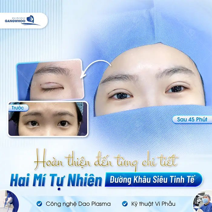 Cắt mí mắt có được vĩnh viễn không? Cách duy trì mí mắt đẹp lâu dài