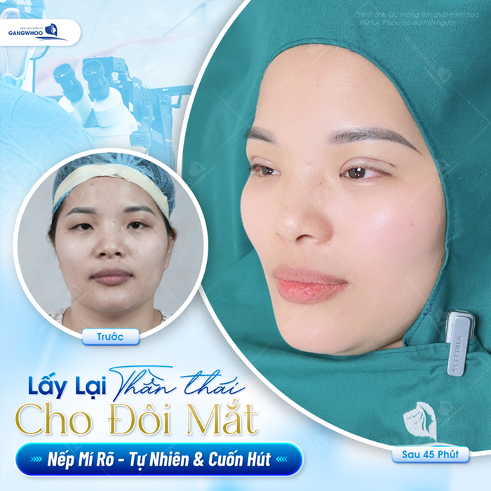 Cắt mí Plasma là gì? Có nên lựa chọn phương pháp cắt mí Plasma?