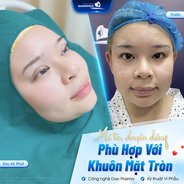 Cắt mí Plasma là gì? Có nên lựa chọn phương pháp cắt mí Plasma?