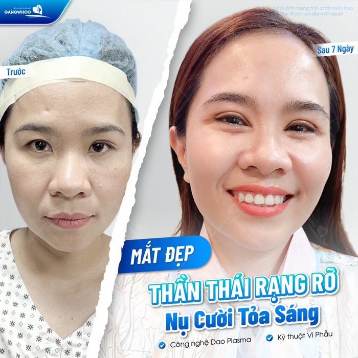 Cắt mí Plasma là gì? Có nên lựa chọn phương pháp cắt mí Plasma?