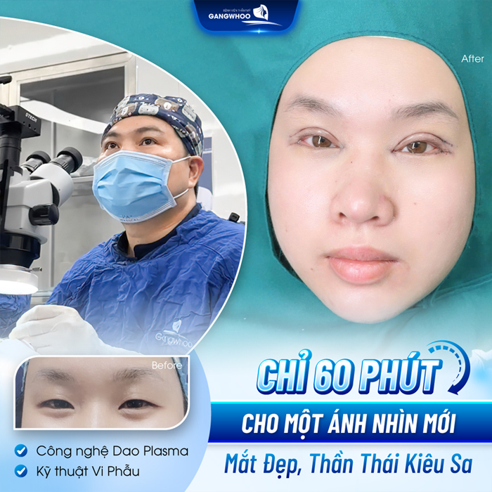Cắt mí Plasma là gì? Có nên lựa chọn phương pháp cắt mí Plasma?