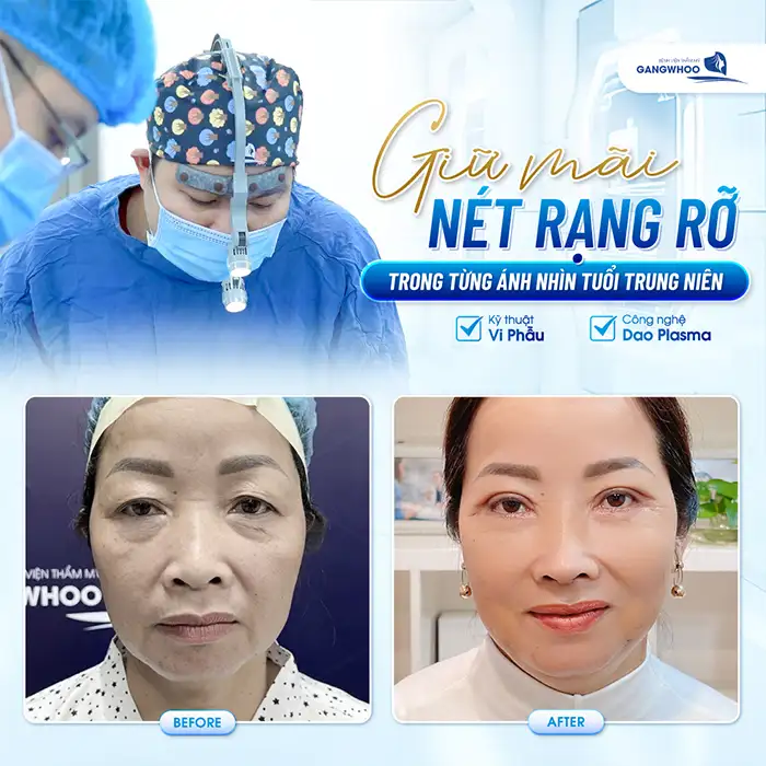 Cắt mí Plasma giữ được bao lâu? Những lưu ý khi chăm sóc sau cắt mí