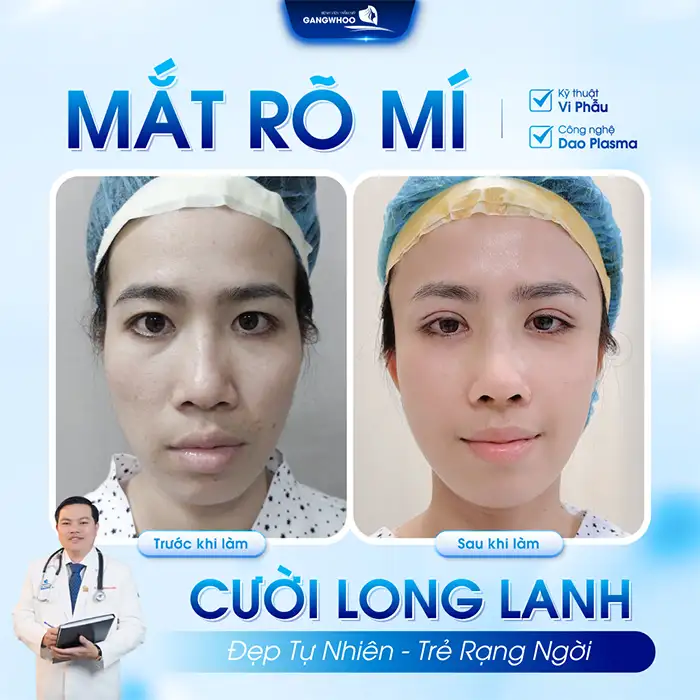 Cắt mí Plasma giữ được bao lâu? Những lưu ý khi chăm sóc sau cắt mí