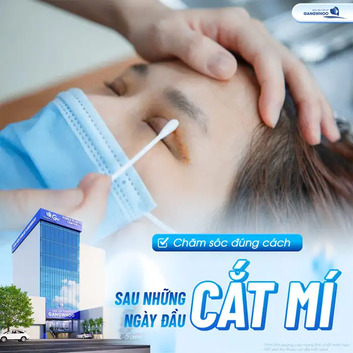 Cắt mí Plasma giữ được bao lâu? Những lưu ý khi chăm sóc sau cắt mí