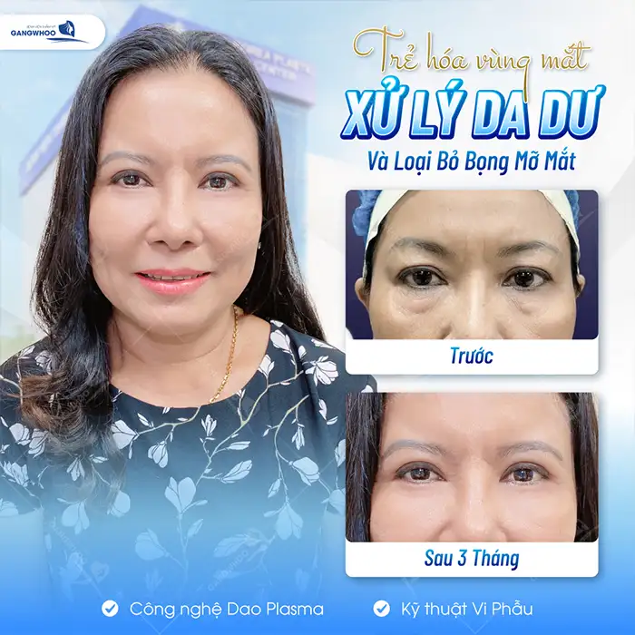 Cắt mí sâu tây là gì? Có nên lựa chọn cắt mí sâu tây không?