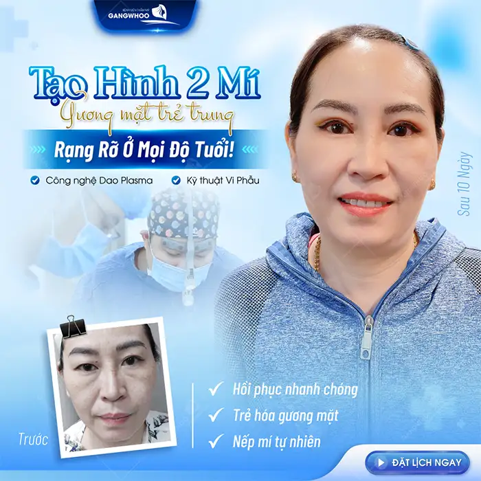 Cắt mí sâu tây là gì? Có nên lựa chọn cắt mí sâu tây không?