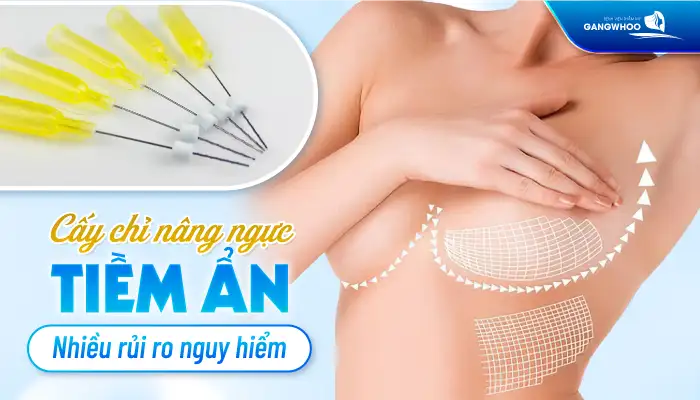 Cấy chỉ nâng ngực là gì? Cấy chỉ nâng ngực có an toàn không?