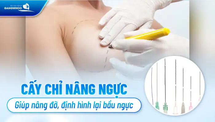Cấy chỉ nâng ngực là gì? Cấy chỉ nâng ngực có an toàn không?