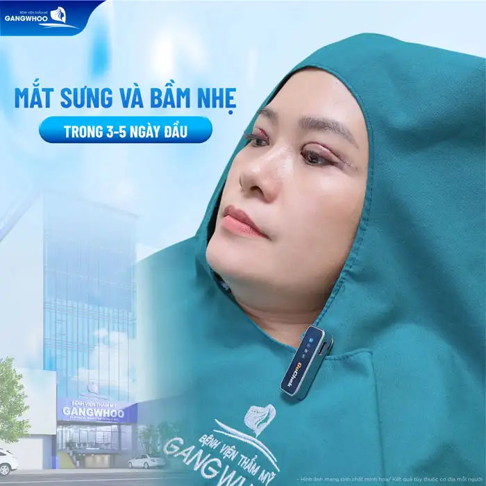 Cách chăm sóc mắt sau khi cắt mí mắt đúng cách giúp hồi phục nhanh