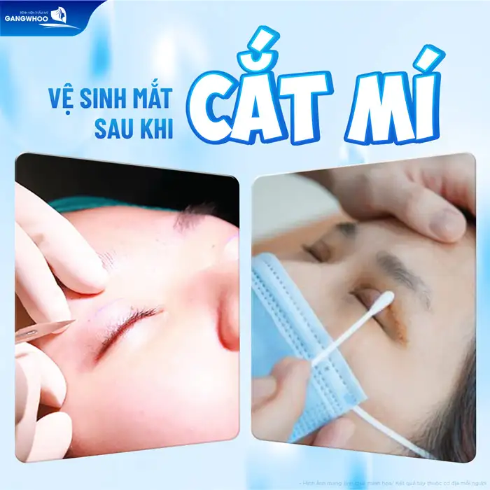 Cách chăm sóc mắt sau khi cắt mí mắt đúng cách giúp hồi phục nhanh