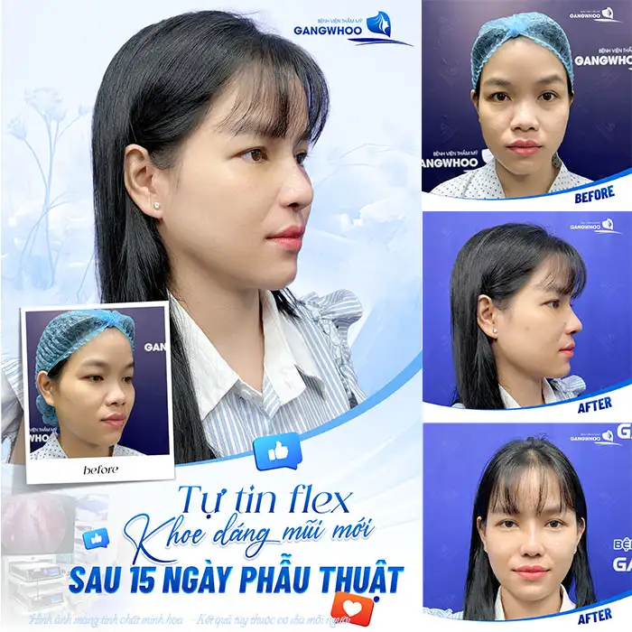 Có kinh có nâng mũi được không? Cần phải tránh không?