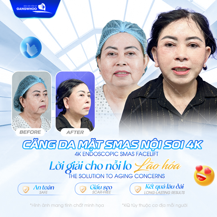 Có nên căng da mặt không? Phương pháp căng da mặt nào hiệu quả, an toàn?