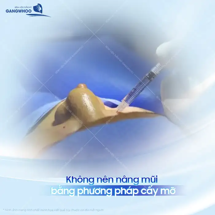 Có nên nâng mũi bằng mỡ tự thân không? Liệu có gây biến chứng gì không?