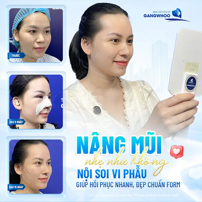 Có nên nâng mũi sau khi nâng ngực không? Cần lưu ý gì?