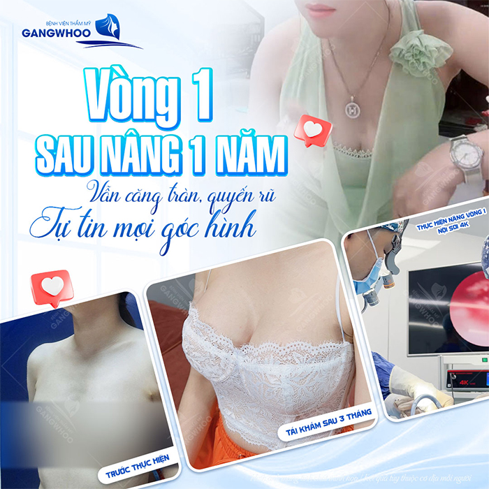 Có nên nâng ngực bằng túi nano chip không? Ưu, nhược điểm ra sao
