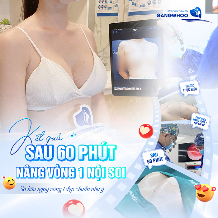 Có nên nâng ngực nội soi không? Ưu điểm khi nâng ngực nội soi