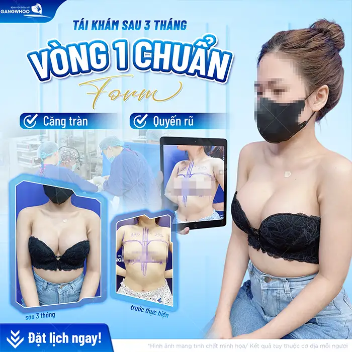 Có nên nâng ngực trước khi sinh con không? Có ảnh hưởng gì không?