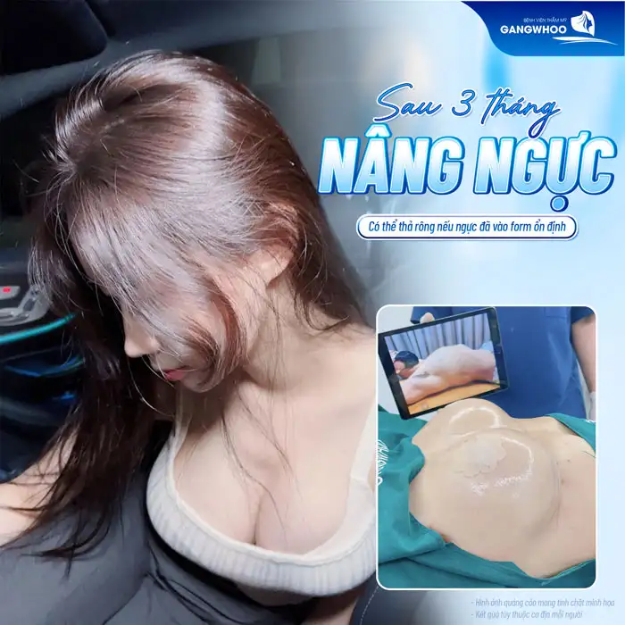 Có nên thả rông sau nâng ngực không? Có ảnh hưởng đến dáng ngực