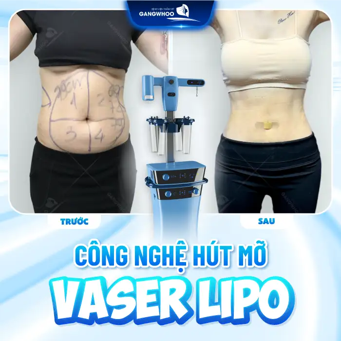 Top công nghệ hút mỡ hiện đại nhất hiện nay là gì? Nên lựa chọn công nghệ nào?